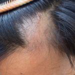 Come riconoscere l'alopecia: tutti i metodi