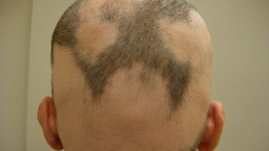 alopecia areata maschie e femminile