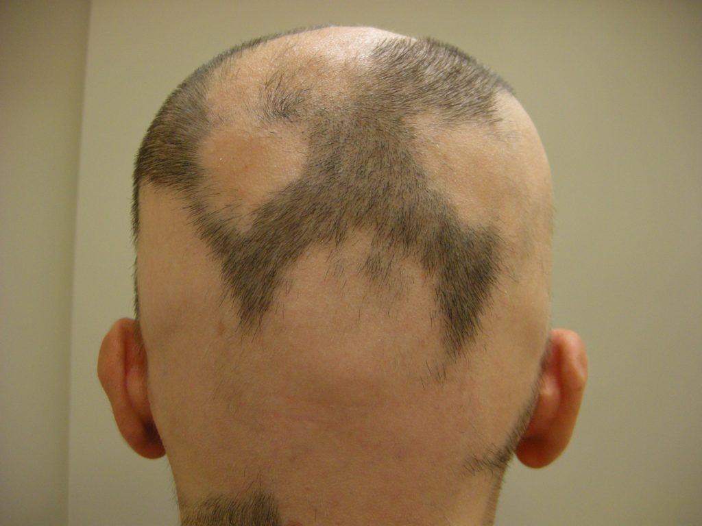 alopecia areata sintomi e cause