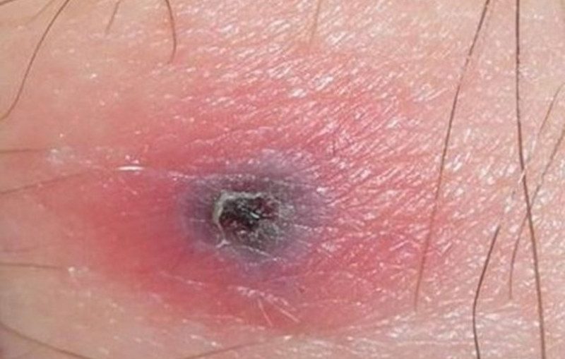 terapia antibiotica per morsi di zecca