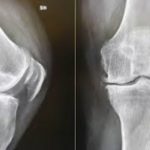 Come combattere e alleviare il dolore causato dall’artrosi di ginocchio?