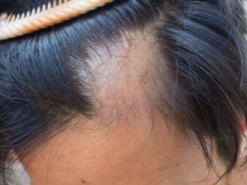 alopecia_800x526