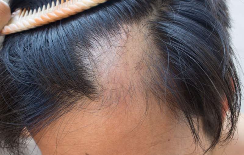 alopecia_800x526