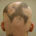 Riconoscere la tipologia di alopecia per risolvere il problema